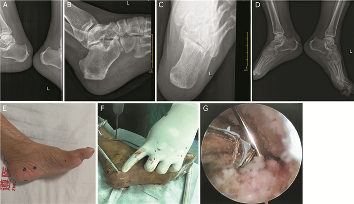跟骨骨刺手术图片