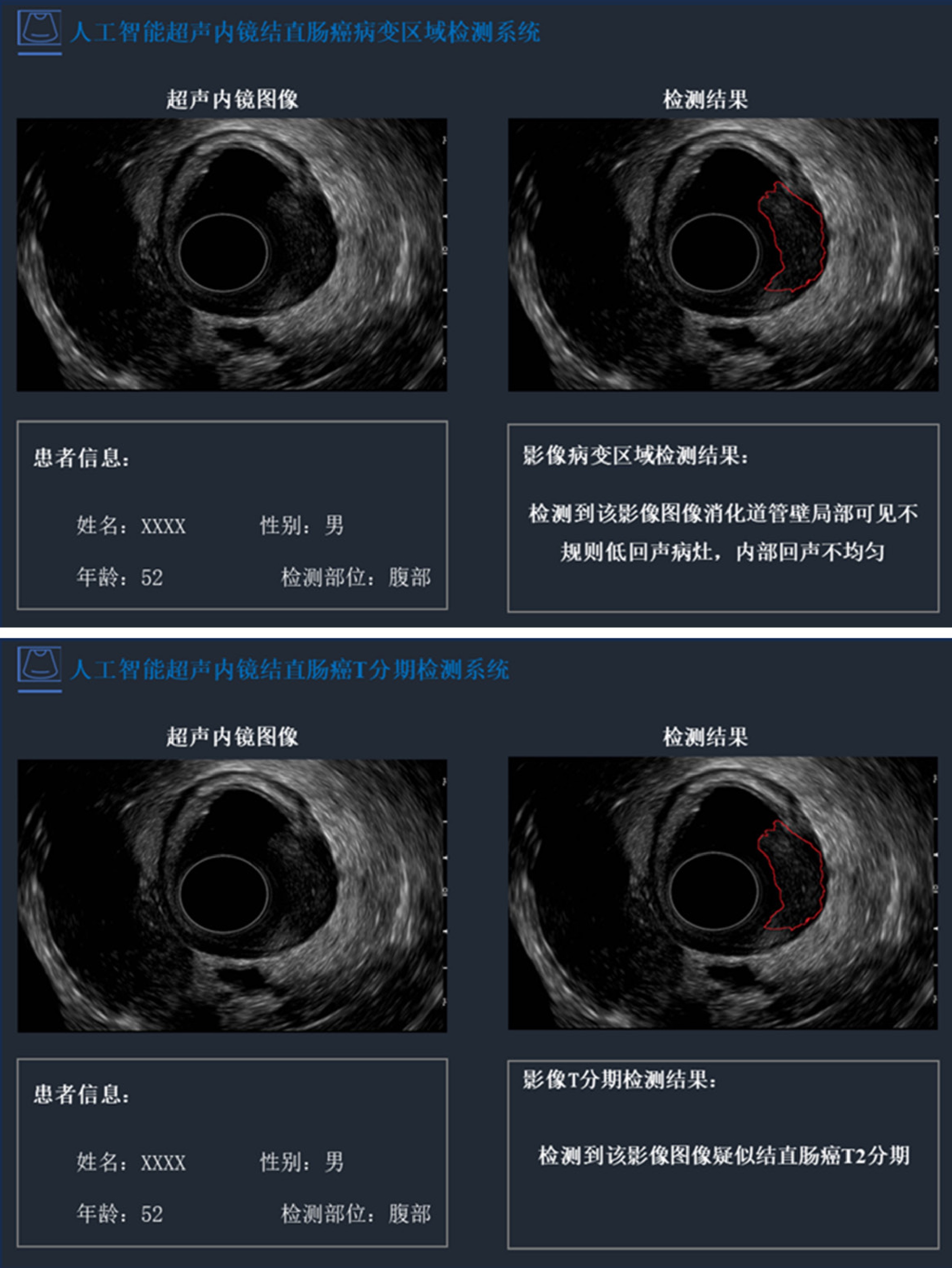 结直肠癌病变及T分期检测用户界面图